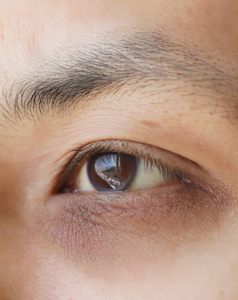 Tired Eyes, Dark Circles and Eye Bags